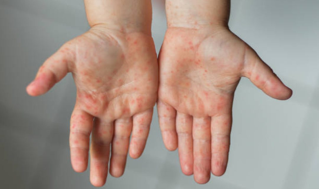 Enterovirus Legs hands mouth Rash on the body of a child Cocksackie virus